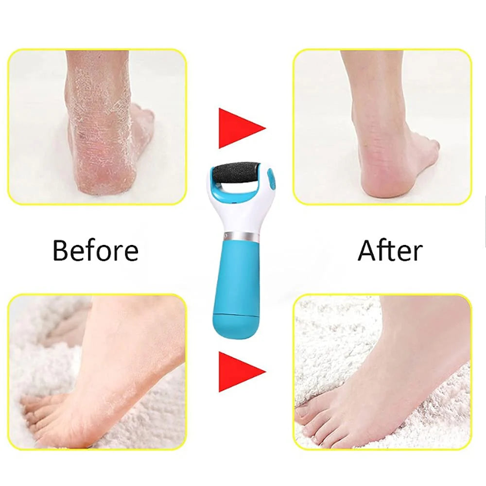 Foot Roller Callus Remover | Callus Remover Foot Scrubber Dead Skin Remover For Feet - Foot Roller Callus Remover